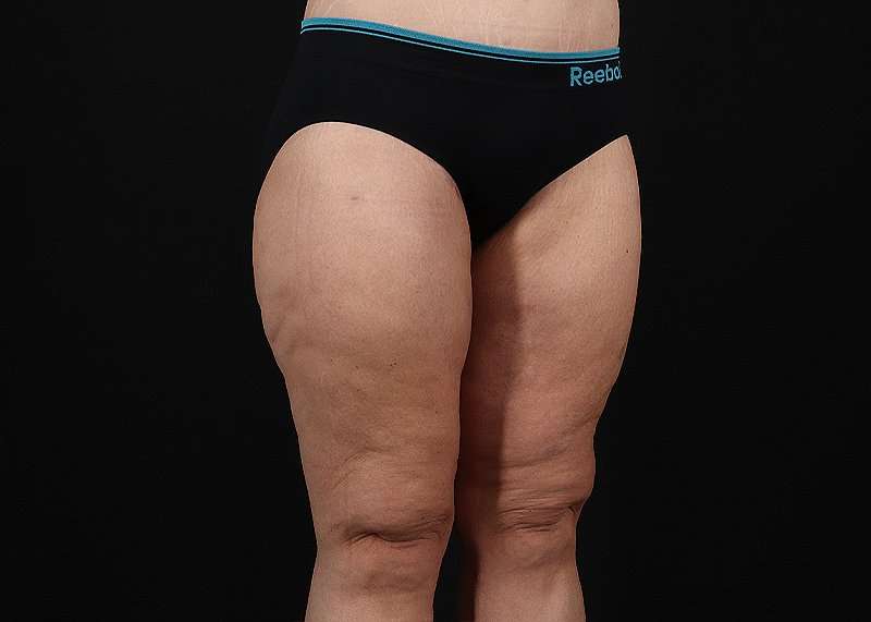 Thigh Lift Before & After Patient #3109
