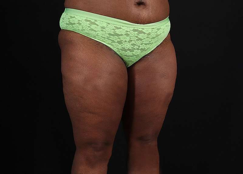 Thigh Lift Before & After Patient #3122