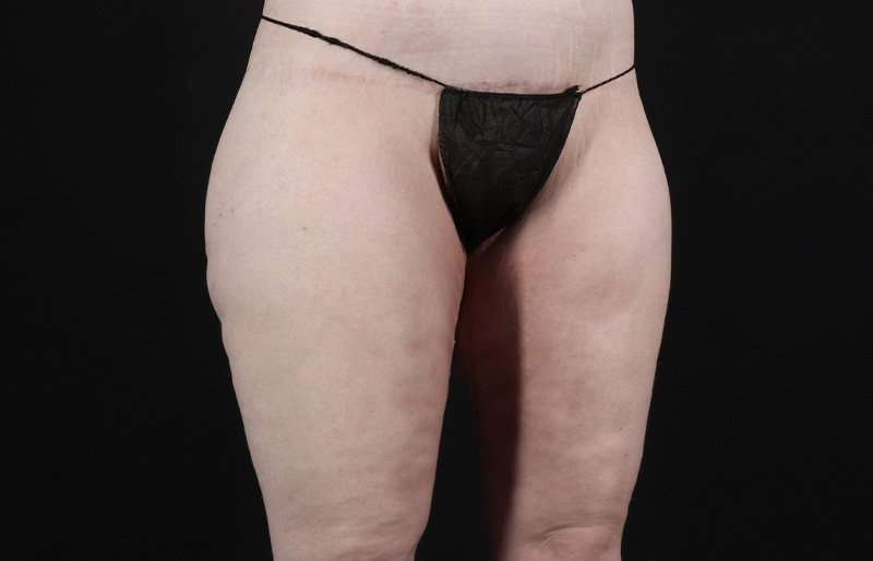 Thigh Lift Before & After Patient #3135