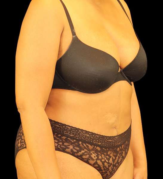 Tummy Tuck Revision Before & After Patient #3146