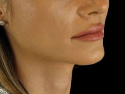 Lip Augmentation - Fat Grafting Before & After Patient #3210