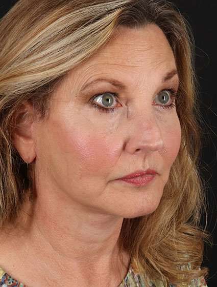 Face & Neck Lift Before & After Patient #3259