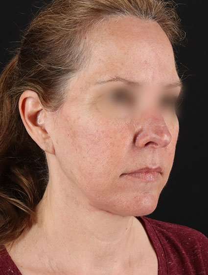 Face & Neck Lift Before & After Patient #3270