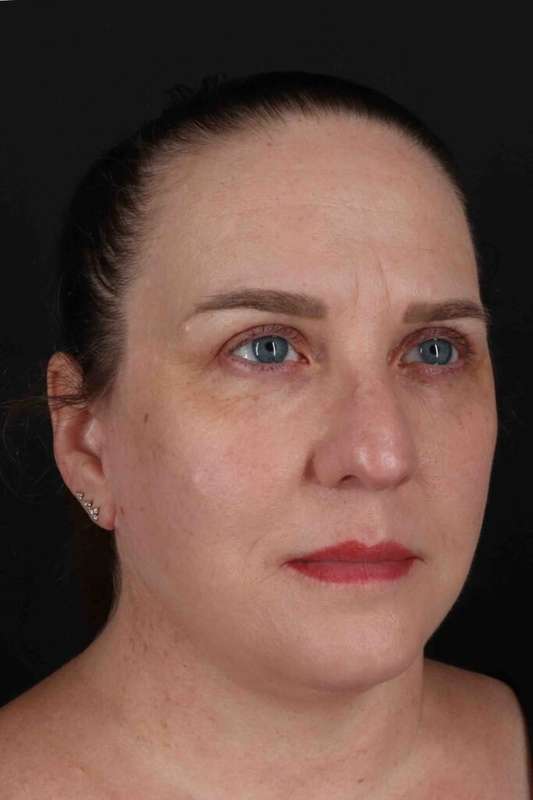 Face & Neck Lift Before & After Patient #3303