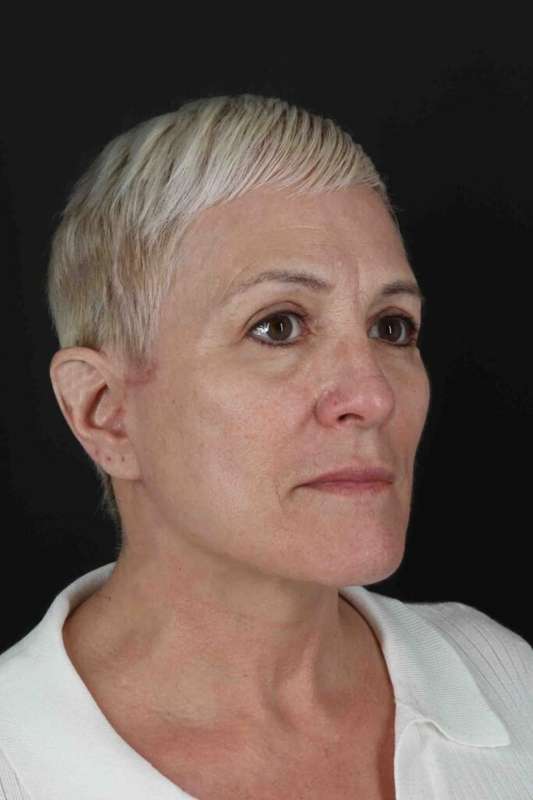 Face & Neck Lift Before & After Patient #3314
