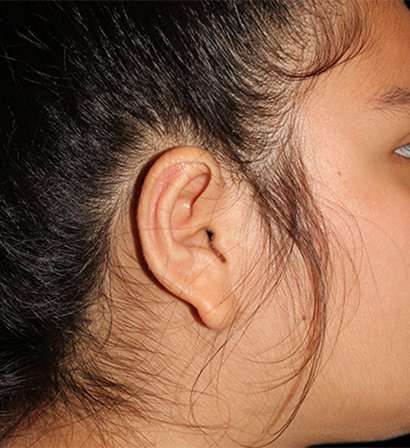 Otoplasty Before & After Patient #3319