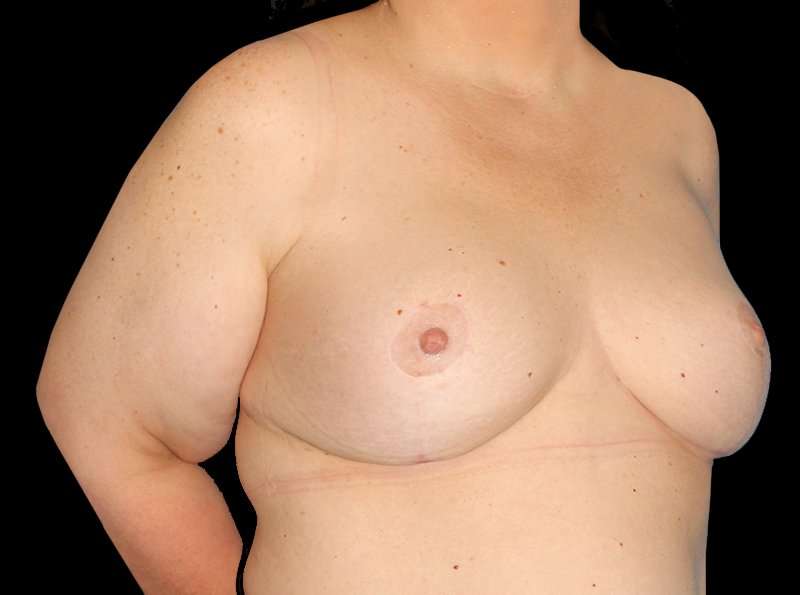 Revision Breast Surgery Before & After Patient #1195