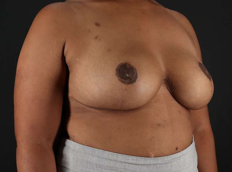 Breast Reduction Before & After Patient #1228