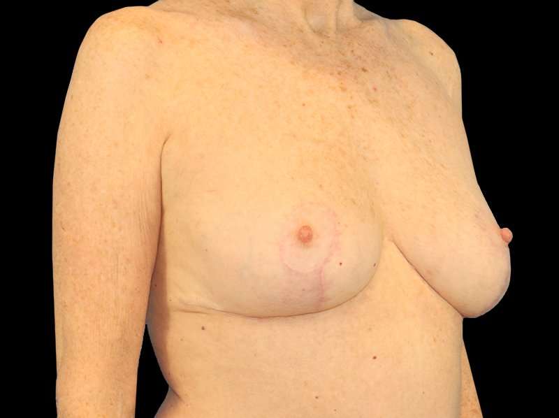 Breast Reduction Before & After Patient #1239
