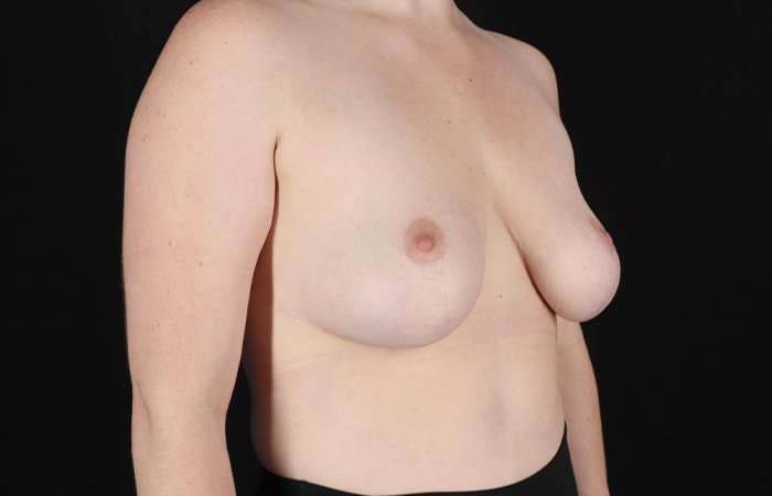 Breast Reduction Before & After Patient #1250