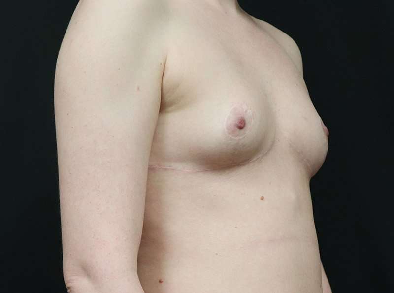 Breast Reduction Before & After Patient #1261