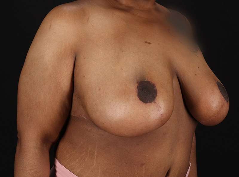 Breast Reduction Before & After Patient #1272