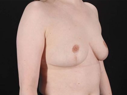 Breast Reduction Before & After Patient #1305