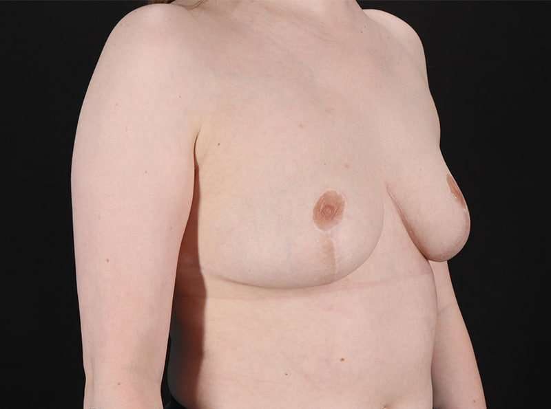Breast Reduction Before & After Patient #1305