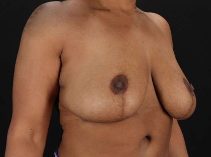 Breast Reduction Before & After Patient #1387