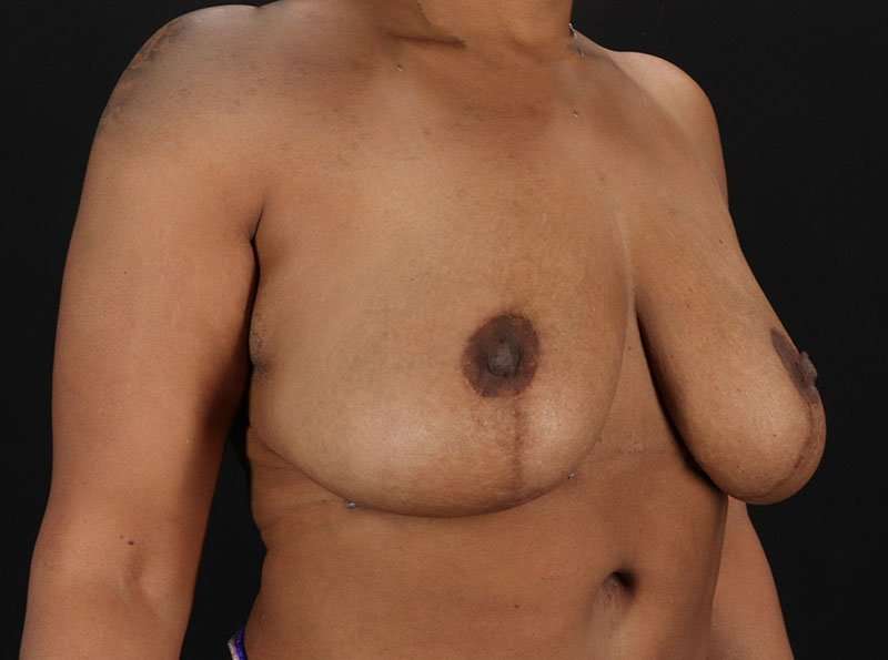 Breast Reduction Before & After Patient #1387