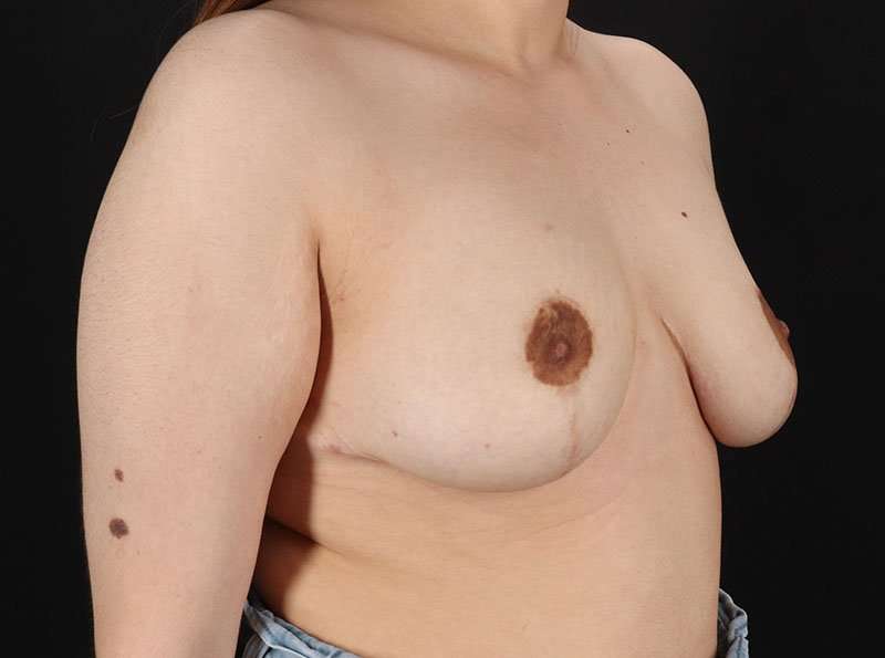 Breast Reduction Before & After Patient #1398