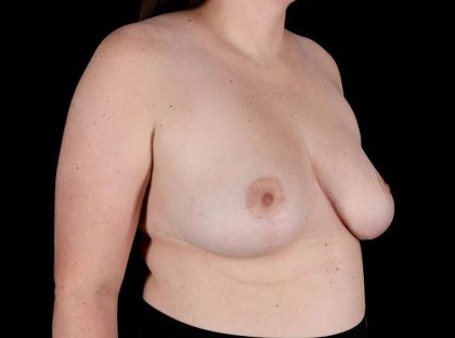 Breast Reduction Before & After Patient #1409