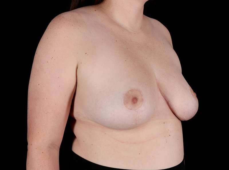 Breast Reduction Before & After Patient #1409