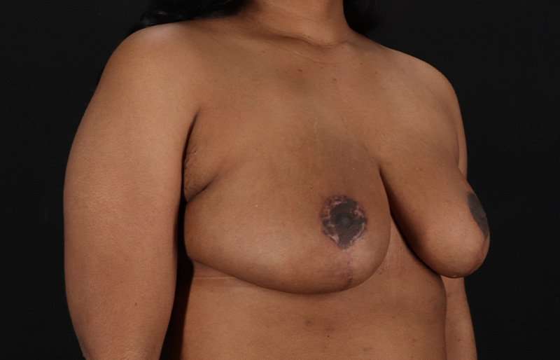 Breast Reduction Before & After Patient #1431