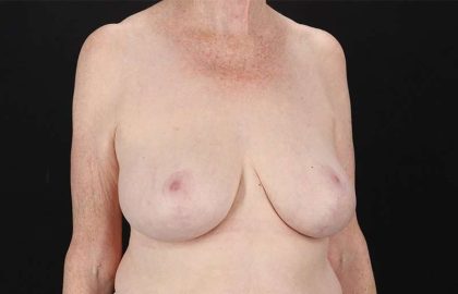 Breast Reduction Before & After Patient #1442