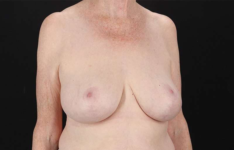 Breast Reduction Before & After Patient #1442