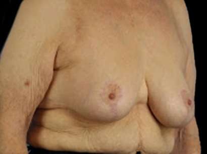 Breast Reduction Before & After Patient #1464