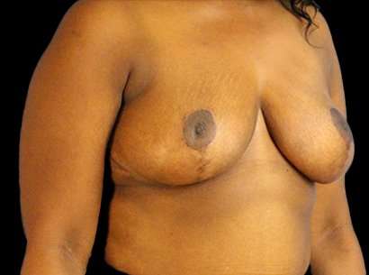 Breast Reduction Before & After Patient #1475