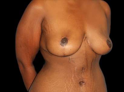 Breast Reduction Before & After Patient #1486