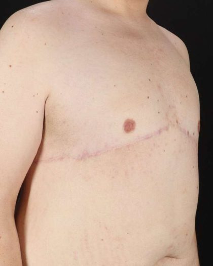 Gynecomastia Before & After Patient #1603