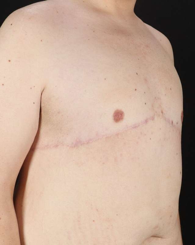 Gynecomastia Before & After Patient #1603