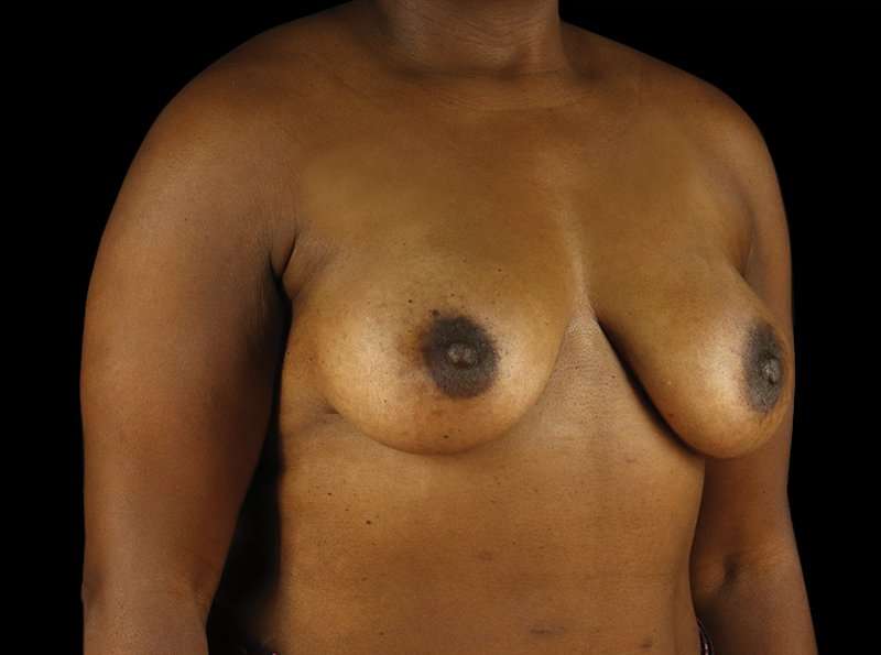 Breast Augmentation - Implant Before & After Patient #954
