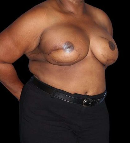 DIEP Flap Reconstruction Before & After Patient #1623