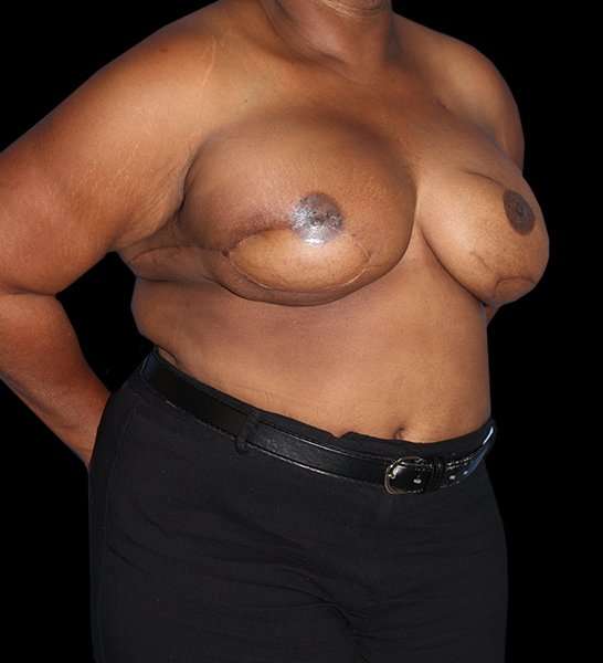 DIEP Flap Reconstruction Before & After Patient #1623