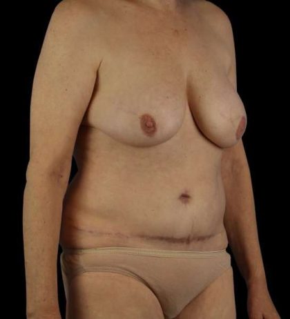 DIEP Flap Reconstruction Before & After Patient #1634