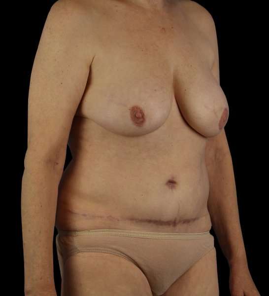 DIEP Flap Reconstruction Before & After Patient #1634