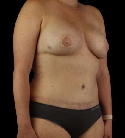 DIEP Flap Reconstruction Before & After Patient #1645