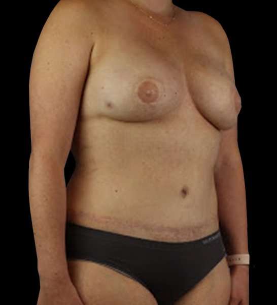 DIEP Flap Reconstruction Before & After Patient #1645