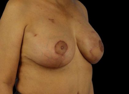 DIEP Flap Reconstruction Before & After Patient #1707
