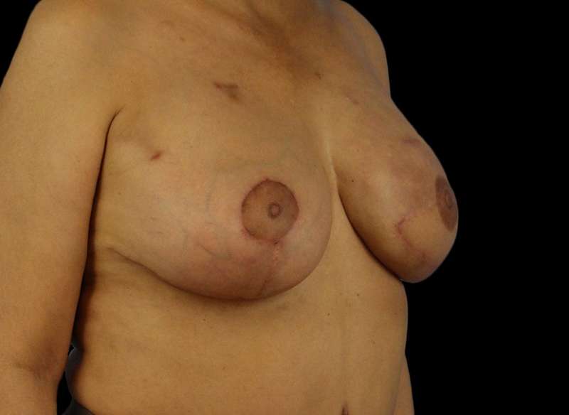 DIEP Flap Reconstruction Before & After Patient #1707