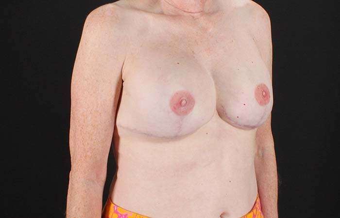 Implant Based Breast Reconstruction Before & After Patient #1718
