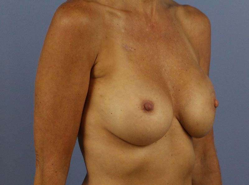 Implant Based Breast Reconstruction Before & After Patient #1729