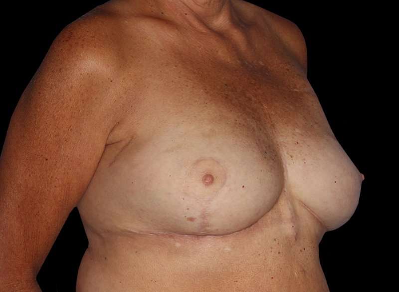 Oncoplastic Reconstruction Before & After Patient #1762