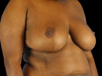 Oncoplastic Reconstruction Before & After Patient #1784