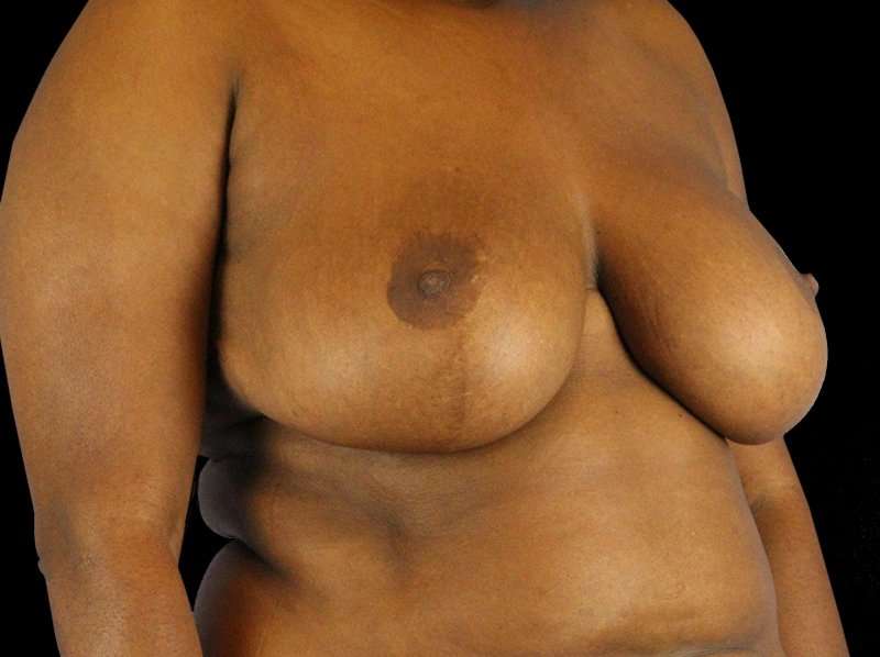 Oncoplastic Reconstruction Before & After Patient #1784