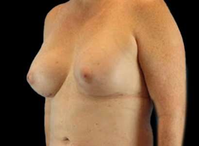 MTF Breast Augmentation Before & After Patient #1802