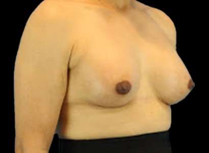 MTF Breast Augmentation Before & After Patient #1809