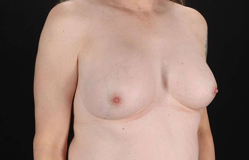 MTF Breast Augmentation Before & After Patient #1831