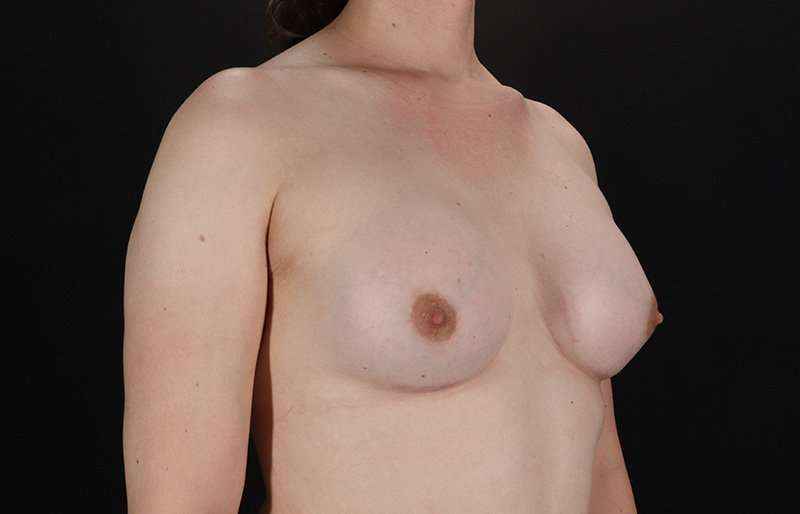 MTF Breast Augmentation Before & After Patient #1842