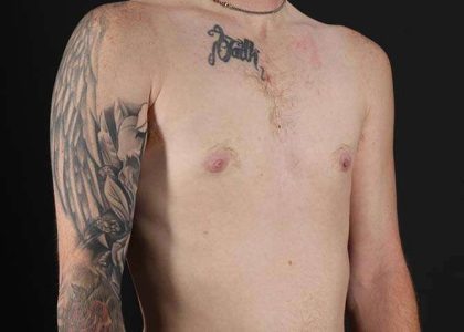 FTM Chest Contouring Before & After Patient #1864